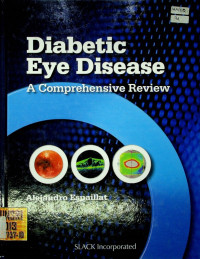 Diabetic Eye Disease; A Comprehensive Review