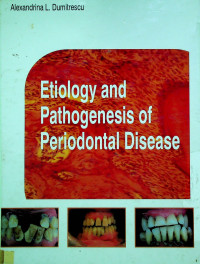 Etiology and Pathogenesis of Periodontal Disease