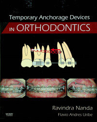 Temporary Anchorage Devices IN ORTHODONTICS