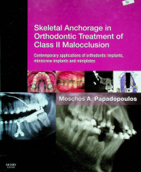 Skeletal Anchorage in Orthodontic Treatment of Class II Malocclusion: Contemporary applications of orthodontic implants, miniscrew implants and miniplates